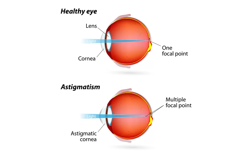 que-es-astigmatismo