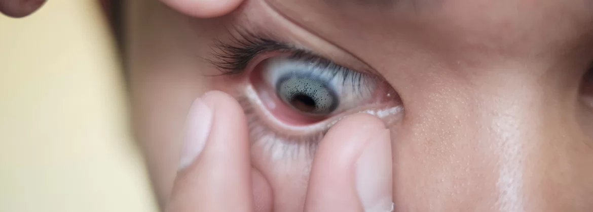 Cómo quitar las lentillas pegadas de los ojos