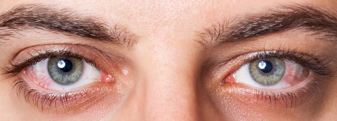 Lentillas y ojos rojos: causas y remedios