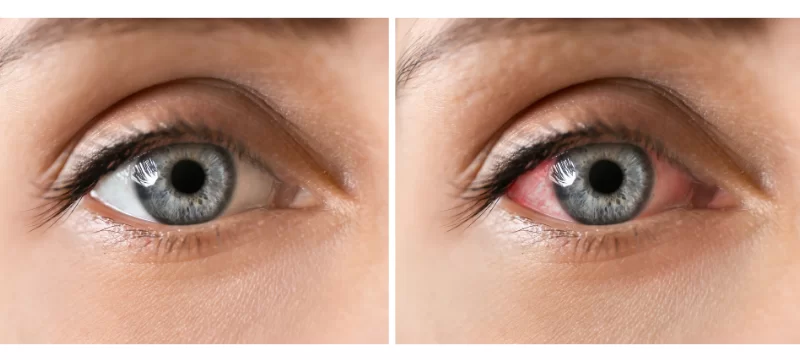 


<p>Son similares a las lentillas convencionales, tanto las que tienen función optométrica como las que son usadas por fines estéticos.</p>



<p>Con una textura blanda, permite la liberación del fármaco de forma controlada para ofrecer una recuperación óptima.</p>



<p> Una vez colocadas en los ojos, se disuelven al pasar unos minutos gracias a los fluidos oculares y los residuos son expulsados sin problemas.</p>



<p>A diferencia de las gotas oftalmológicas, las lentillas biodegradables se aprovechan mejor puesto que, cuándo se aplica la gota sobre el ojo, se pierde una cantidad considerable a través de las lágrimas.</p>



<p>No por ello, deben ser descartadas porque son un tratamiento opcional con el fin de reducir la inflamación en el ojo y, por ende, evitar el riesgo de una complicación.</p>



<h2 class=