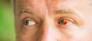 Consecuencias de no tratar un derrame ocular