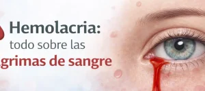Hemolacria: todo sobre las lágrimas de sangre