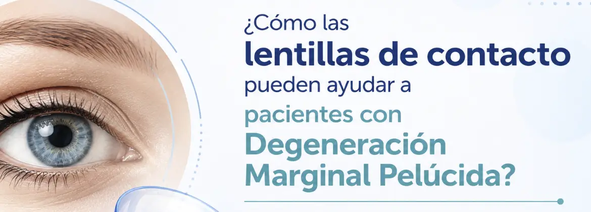 ¿Cómo las lentillas de contacto pueden ayudar a pacientes con Degeneración Marginal Pelúcida?